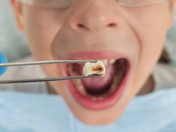 Best Urgent Care for Lost Fillings or Crowns in Martinez, GA