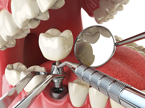 Best Urgent Care for Lost Fillings or Crowns in Martinez, GA